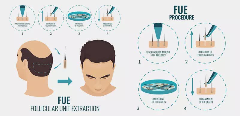 hair transplant in turkey